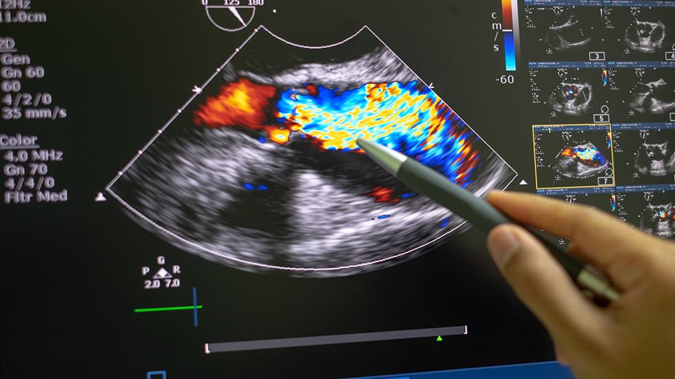 Ecocardiografia (ecocardiogramma): cos'è e quando farla